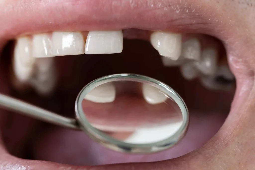 impianti-per-denti-mancanti